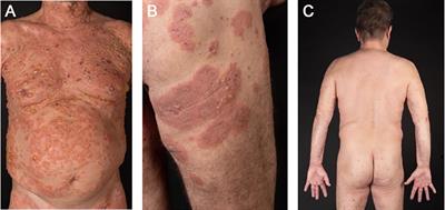 Case report: Bullous pemphigoid in HIV-1-positive patients: interplay or coincidence? A case series and review of the literature